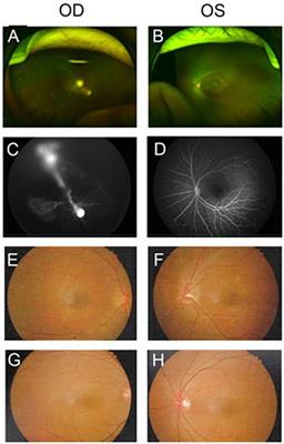 Decrease of FZD4 exon 1 methylation in probands from FZD4-associated FEVR family of phenotypic heterogeneity